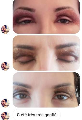 avis plasma lift,avis plasmalift,avis plasma pen,avis plasmapen,test plasmalift,test plasma lift,plasmalift,plasma lift,plasmajet,plasma jet,plasma pen,lifting sans chirurgie,paupières tombantes,cernes,poches,rides,ridules,cicatrices,taches