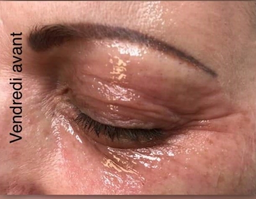 avis plasma lift,avis plasmalift,avis plasma pen,avis plasmapen,test plasmalift,test plasma lift,plasmalift,plasma lift,plasmajet,plasma jet,plasma pen,lifting sans chirurgie,paupières tombantes,cernes,poches,rides,ridules,cicatrices,taches