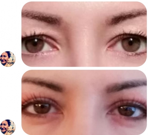 avis plasma lift,avis plasmalift,avis plasma pen,avis plasmapen,test plasmalift,test plasma lift,plasmalift,plasma lift,plasmajet,plasma jet,plasma pen,lifting sans chirurgie,paupières tombantes,cernes,poches,rides,ridules,cicatrices,taches